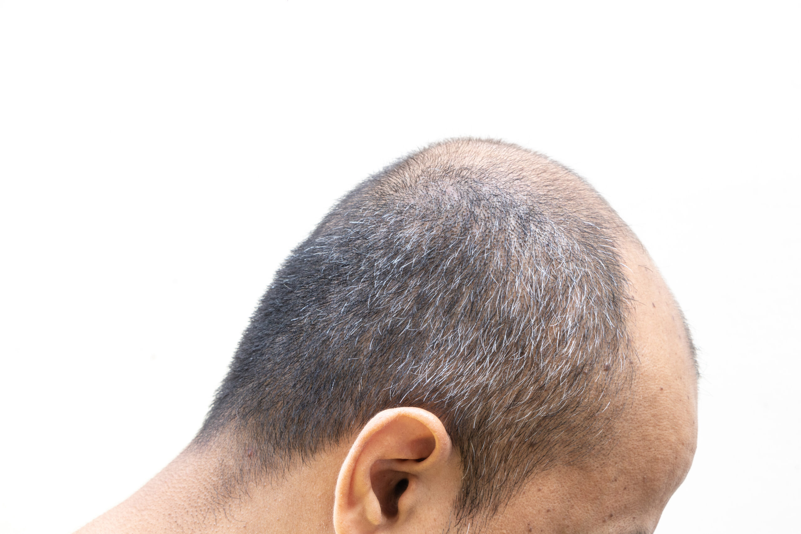 hair transplant Bulent Yaprak back of head balding