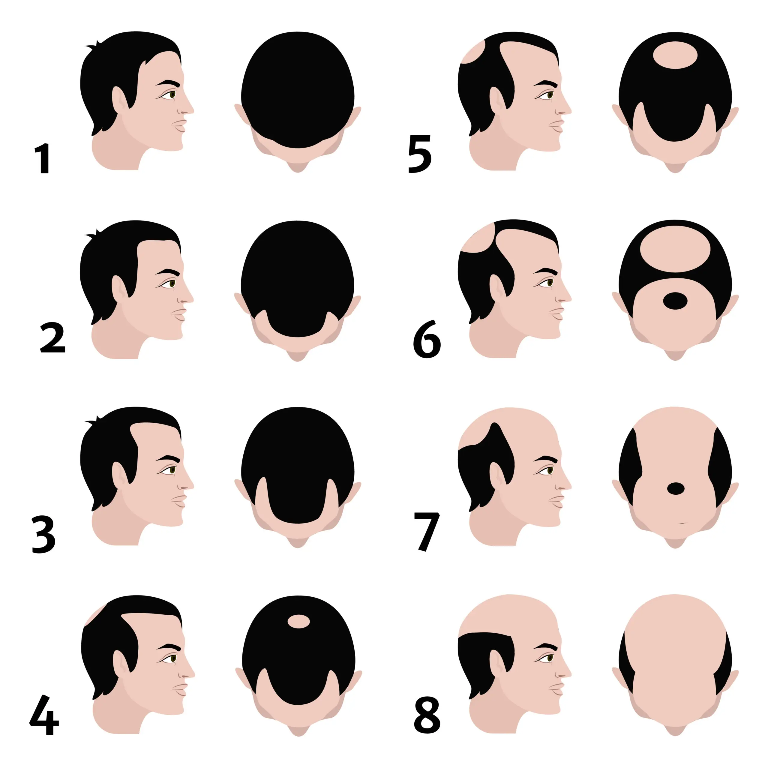 Norwood scale hair loss Bulent Yaprak plastic surgeon