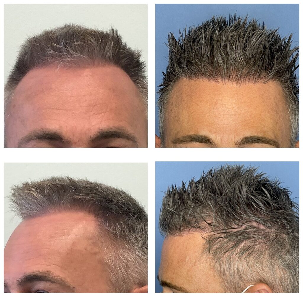 Before and after images hair transplant NZ