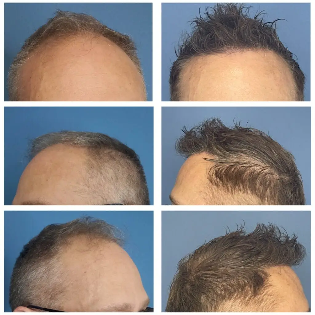 Before and after photos hair transplant bulent yaprak