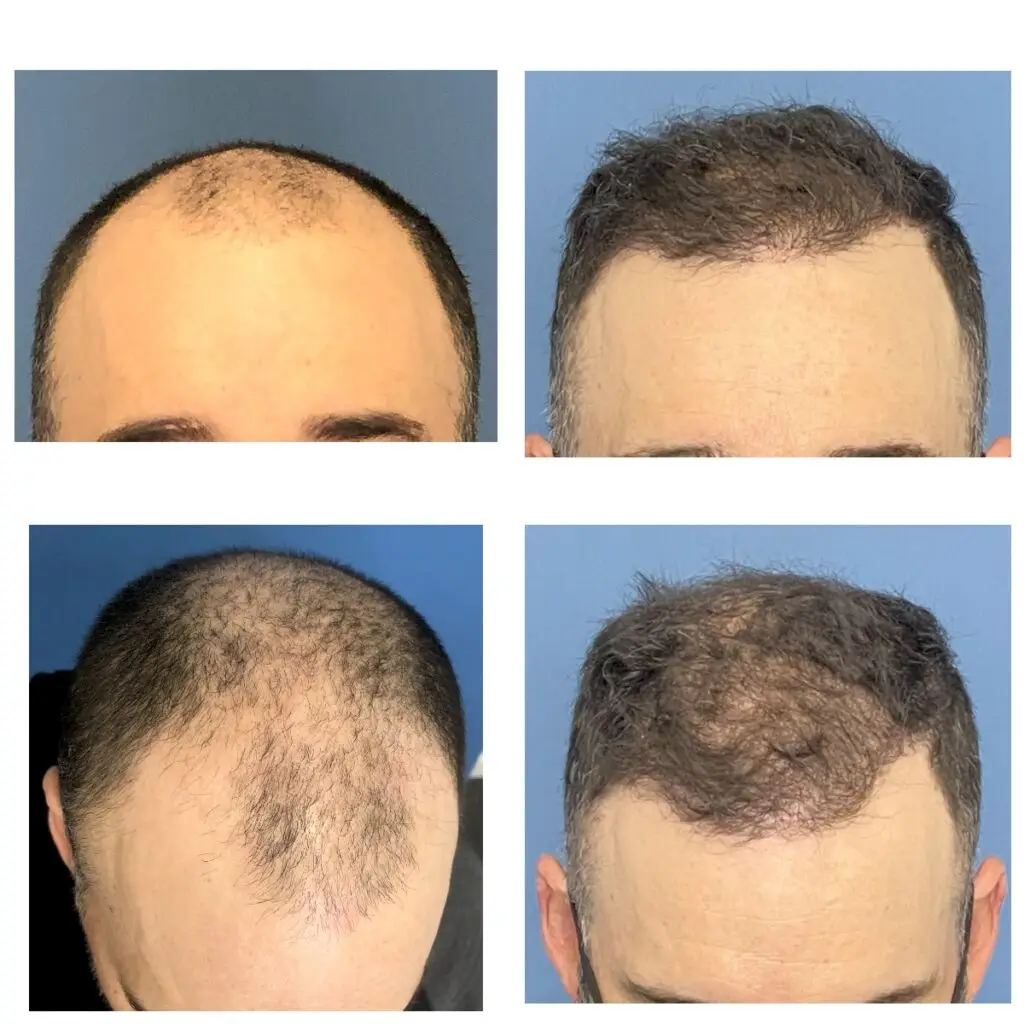 Before and after photos from front and top of head hair transplant