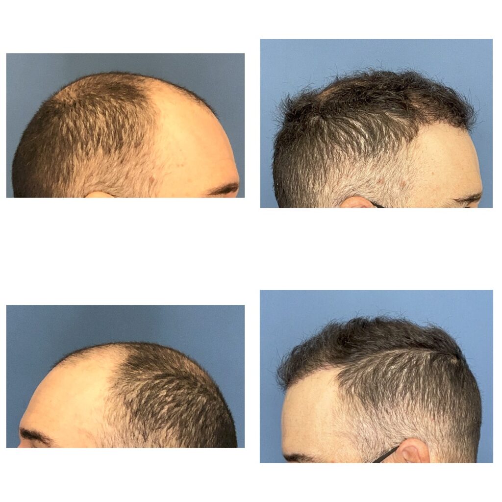 Before and after phtos form side of head hair transplant NZ