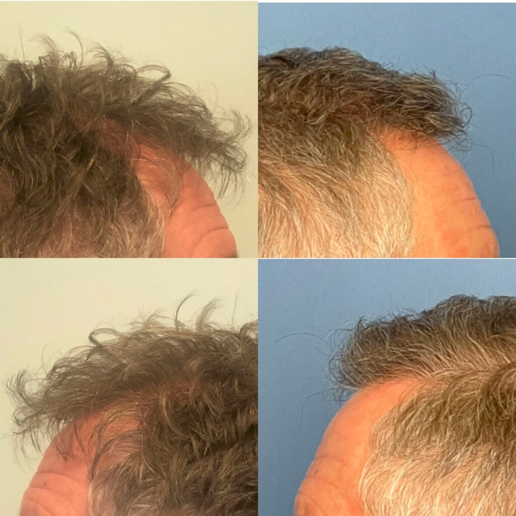 Hair transplant Before and after photos New Zealand - Bulent Yaprak