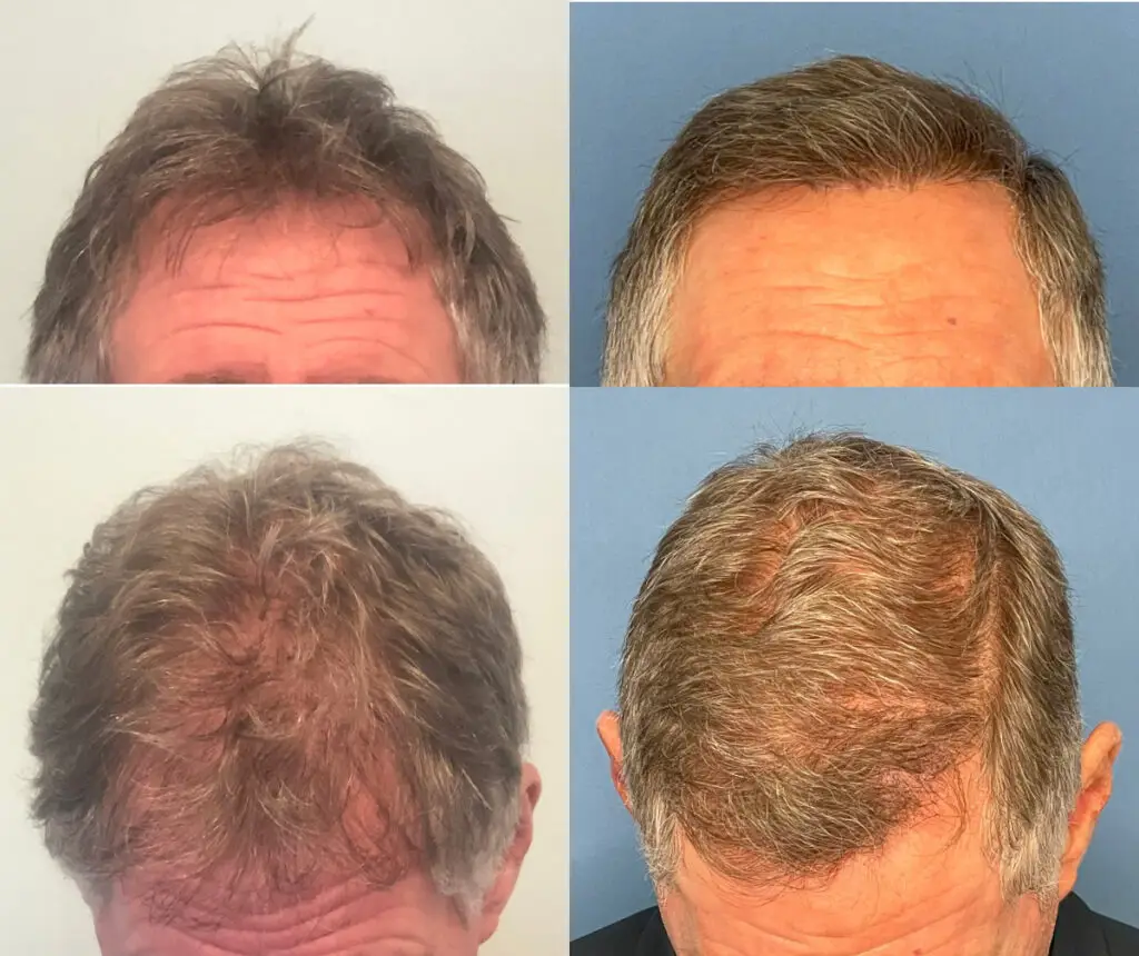 Hair transplant results before and after hair transplant NZ