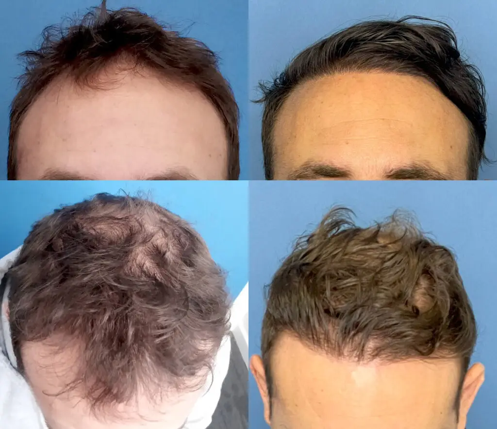 Hair transplant NZ before and after photos